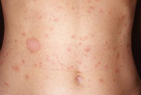 Rash 101: The Most Common Types of Skin Rashes