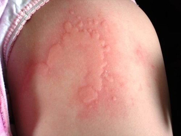 Allergic Reaction Or Mild Inconvenience, How To Tell The Severity Of A Sting