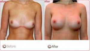Breast Enhancement Procedures: Four Common Procedures