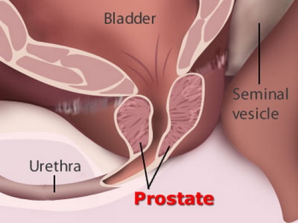 Understanding Your Risk Of Developing Prostate Cancer
