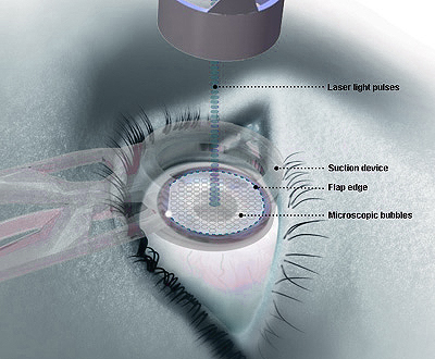 General Information About Laser Eye Surgery – Costs And Risk Factors