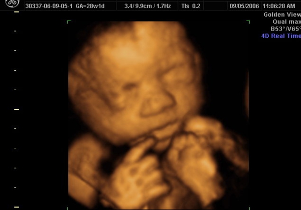 3D And 4D Ultrasounds