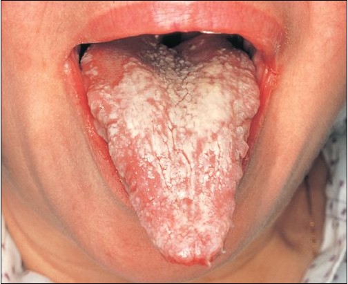 The Symptoms Of Candidiasis