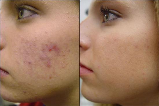 Acne – What Can Be The Best Therapy?