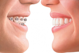 The Benefits Of Clear Braces – Invisalign Treatments