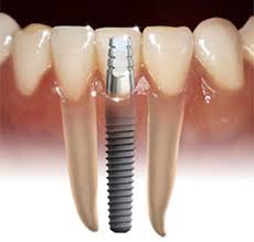Implantation of teeth