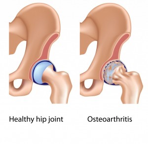 A Brief Look At Osteoarthritis – Symptoms &amp; Causes