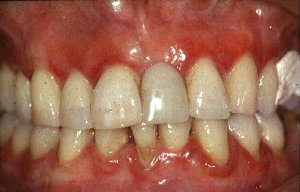 Simple Treatment Of Gum Disease!