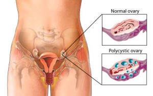 Understanding Polycystic Ovary Syndrome and What Can Be Done to Help It