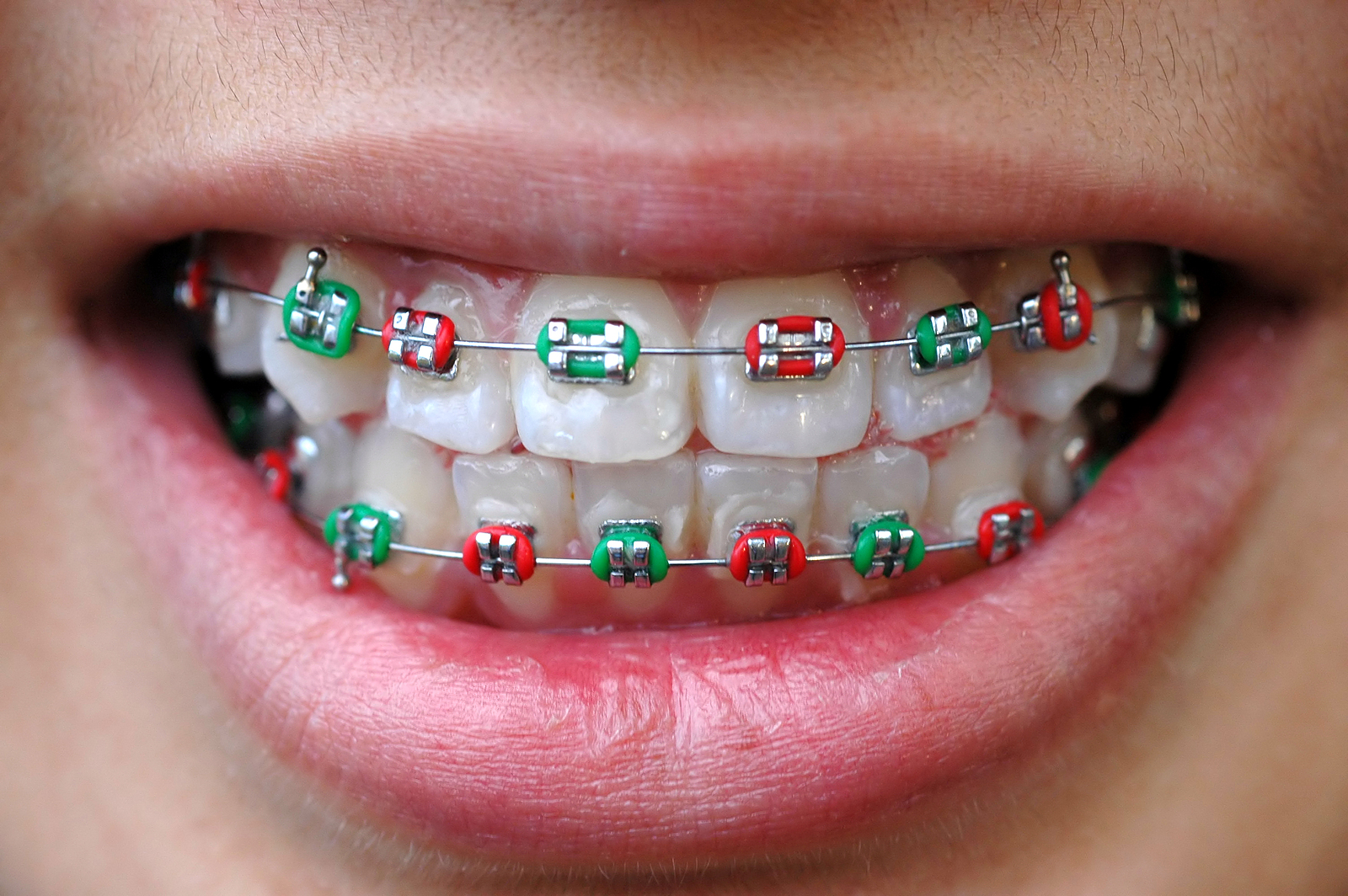 Contemporary Dental Braces