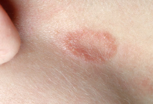 Every Day Must Know About Ringworm