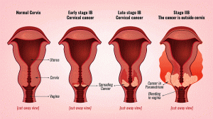 The Different Stages Of Cervical Cancer