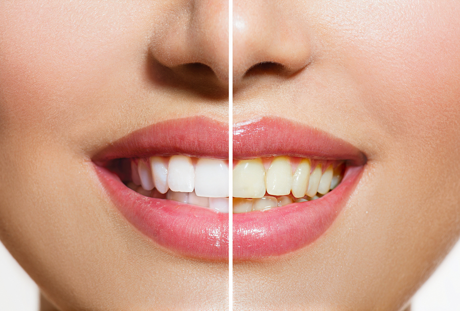What You Should Know Before Scheduling A Professional Teeth Whitening Appointment